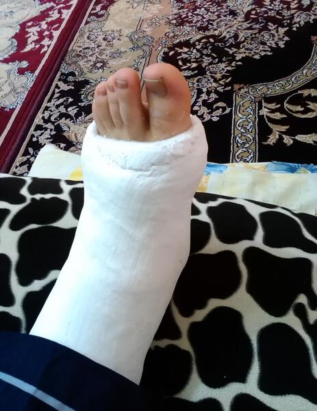 عکس پا شکسته دخترونه فیک