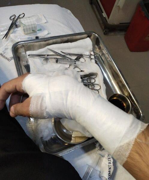 عکس فیک پای شکسته دخترونه