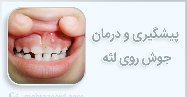 عکس جوش سفید روی زبان