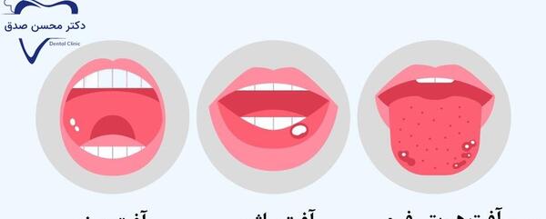 عکس جوش سفید روی زبان