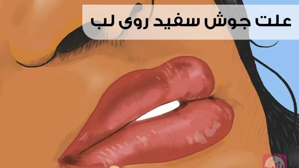عکس جوش سفید روی زبان