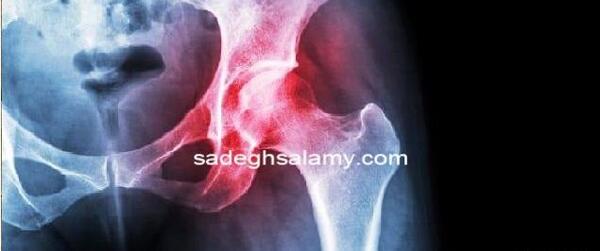 نكروز آواسكولار عکس سیاه شدن استخوان لگن
