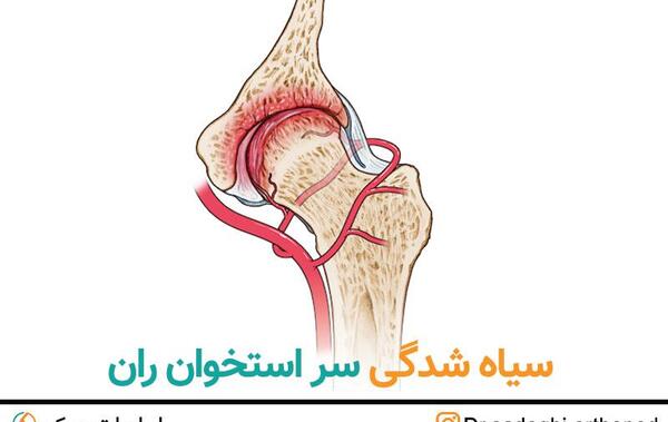 نكروز آواسكولار عکس سیاه شدن استخوان لگن