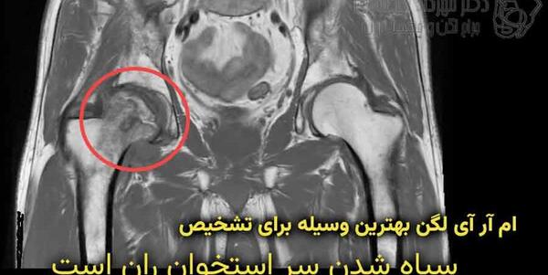 نكروز آواسكولار عکس سیاه شدن استخوان لگن