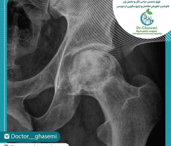 نكروز آواسكولار عکس سیاه شدن استخوان لگن