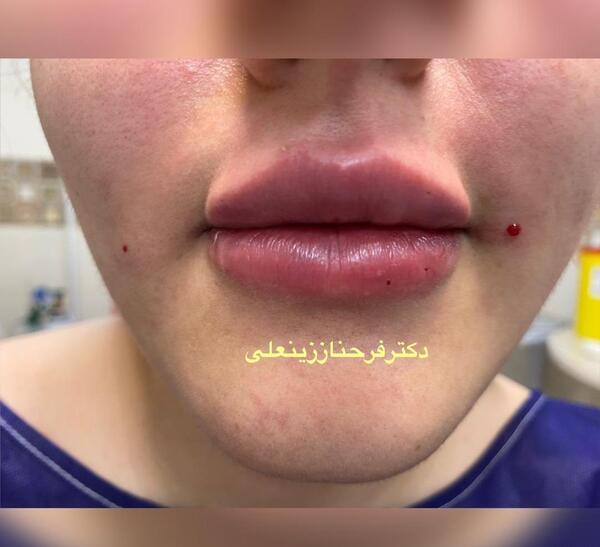 عکس قبل و بعد یک سی سی ژل لب