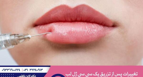 عکس قبل و بعد یک سی سی ژل لب