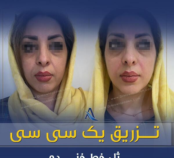 عکس قبل و بعد یک سی سی ژل لب