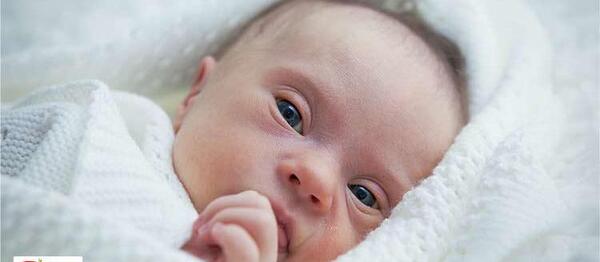 عکس نوزاد مبتلا به سندرم داون