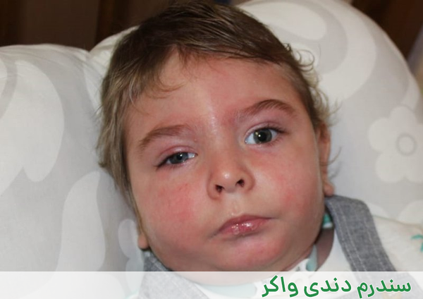 عکس نوزاد مبتلا به سندرم داون