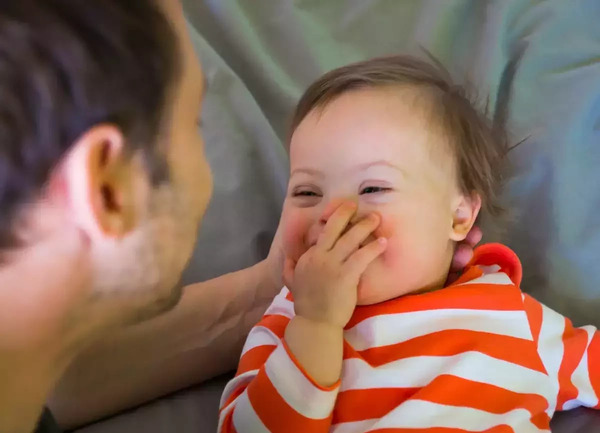 عکس نوزاد مبتلا به سندرم داون