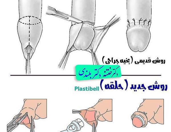 عکس نوزاد تازه ختنه شده