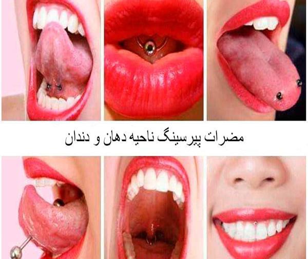 عکس عفونت پیرسینگ زبان