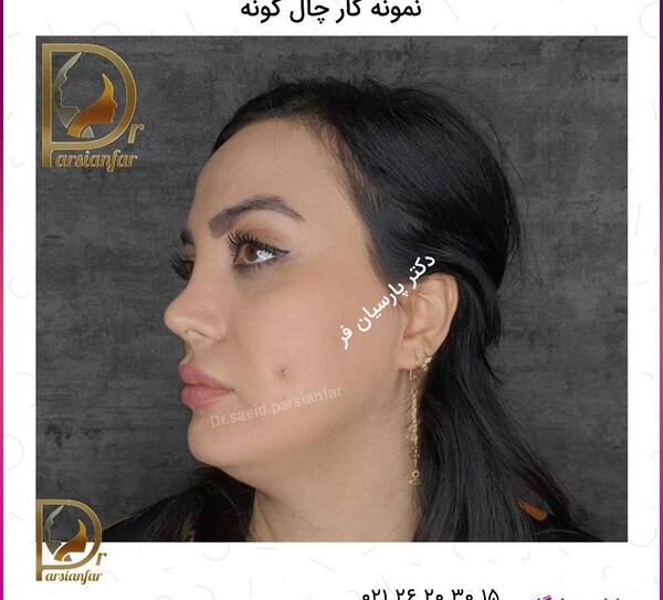 عکس چال گونه با پیرسینگ