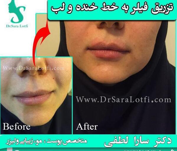 عکس بوتاکس دور لب