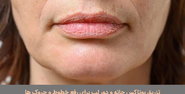عکس بوتاکس دور لب