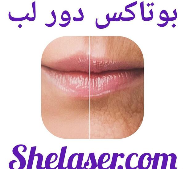 عکس بوتاکس دور لب