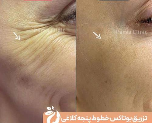 عکس بوتاکس دور لب