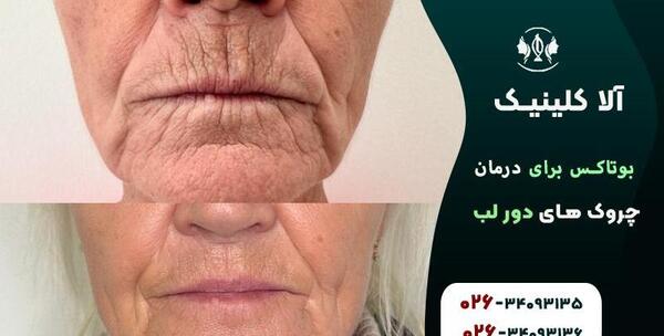 عکس بوتاکس دور لب