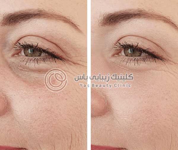 عکس قبل و بعد بوتاکس پیشانی و دور چشم