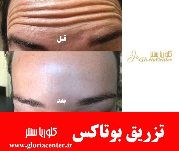 عکس قبل و بعد بوتاکس پیشانی و دور چشم