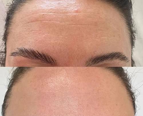 عکس قبل و بعد بوتاکس پیشانی و دور چشم