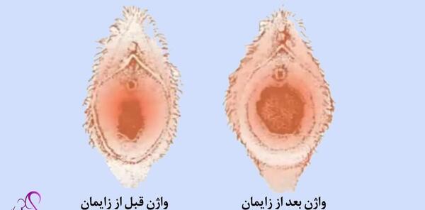 عکس بافت خارج شده از رحم