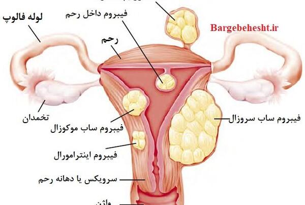 عکس بافت خارج شده از رحم