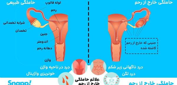 عکس بافت خارج شده از رحم