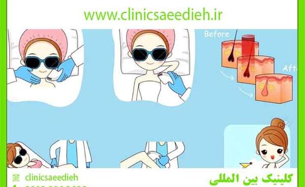 عکس سوتی های لیزر بیکینی نی نی سایت