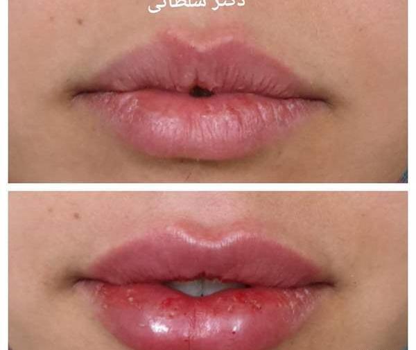 عکس ژل لب مدل سوتی نی نی سایت