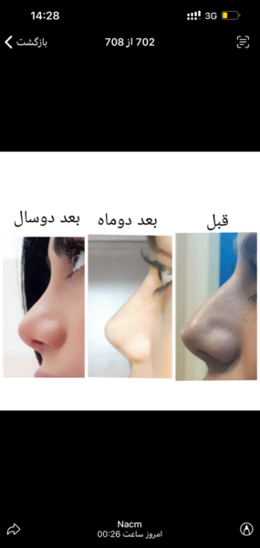 عکس بینیم بعد عمل نی نی سایت