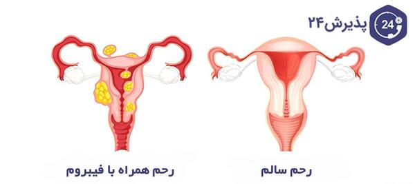 عکس فیبروم دفع شده در پریودی نی نی سایت
