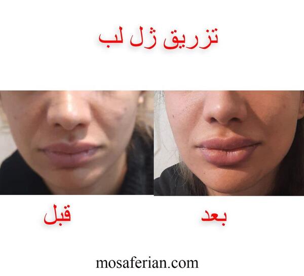 عکس گلوله شدن ژل لب نی نی سایت