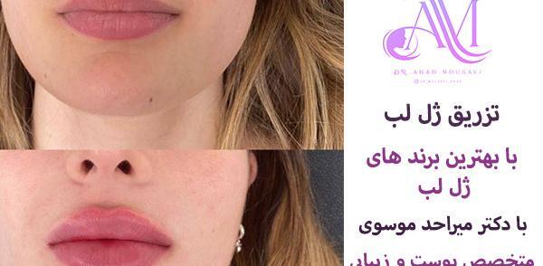 عکس گلوله شدن ژل لب نی نی سایت