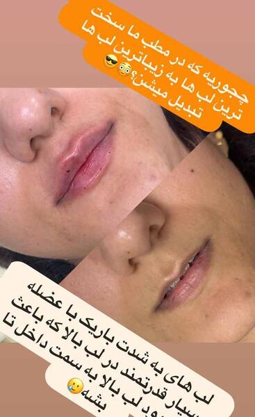 عکس گلوله شدن ژل لب نی نی سایت