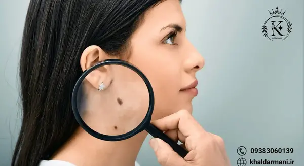 عکس خال گوشتی کشاله ران نی نی سایت