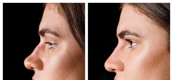 عکس های فیلر بینی