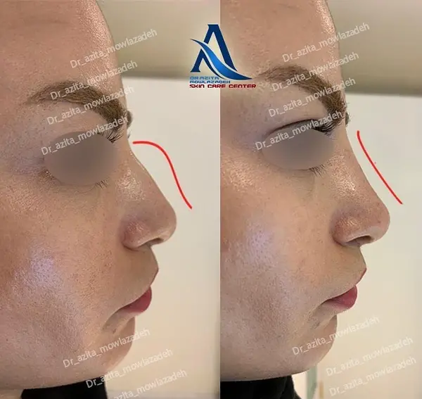 عکس های فیلر بینی