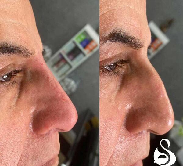 عکس های فیلر بینی