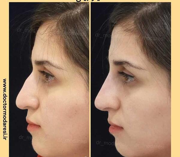 عکس های فیلر بینی