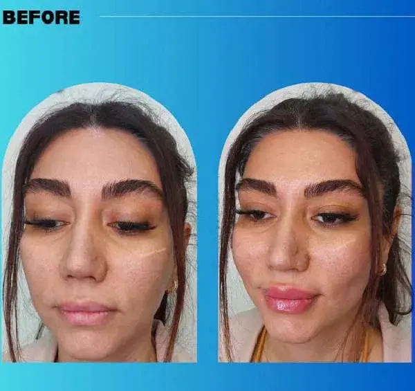 عکس های فیلر بینی
