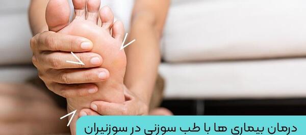 عکس طب سوزنی پا