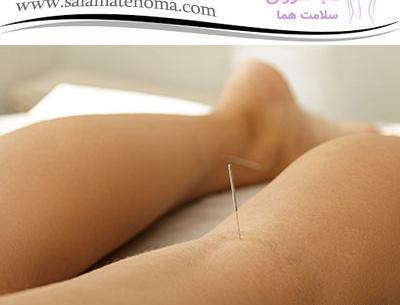 عکس طب سوزنی پا