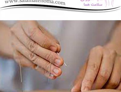 عکس طب سوزنی شکم