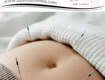عکس طب سوزنی شکم