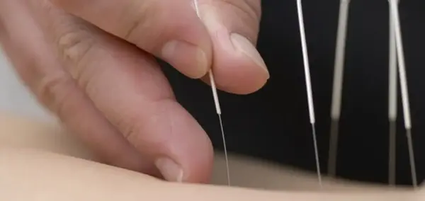 عکس طب سوزنی شکم