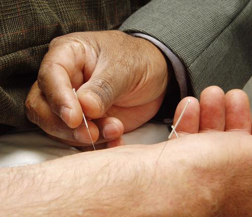 عکس طب سوزنی گردن