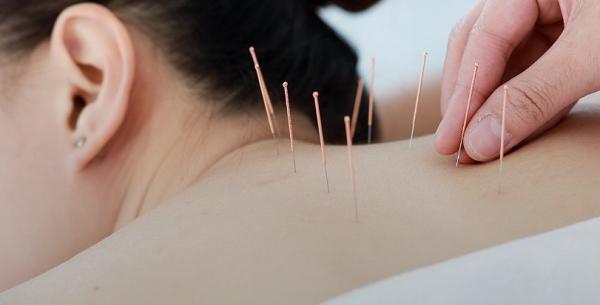 عکس طب سوزنی گردن