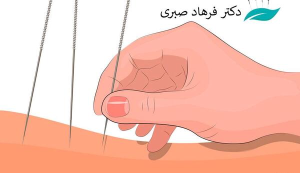 عکس طب سوزنی گردن